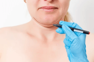 Chin Augmentation