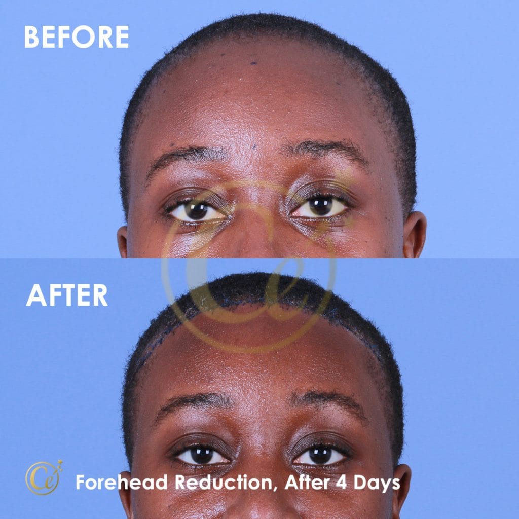 Forehead Reduction Surgery in Turkey - Dr. Cengizhan Ekizceli