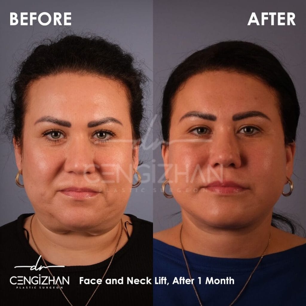 1 Month After Face and Neck Lift Surgery Frontal View