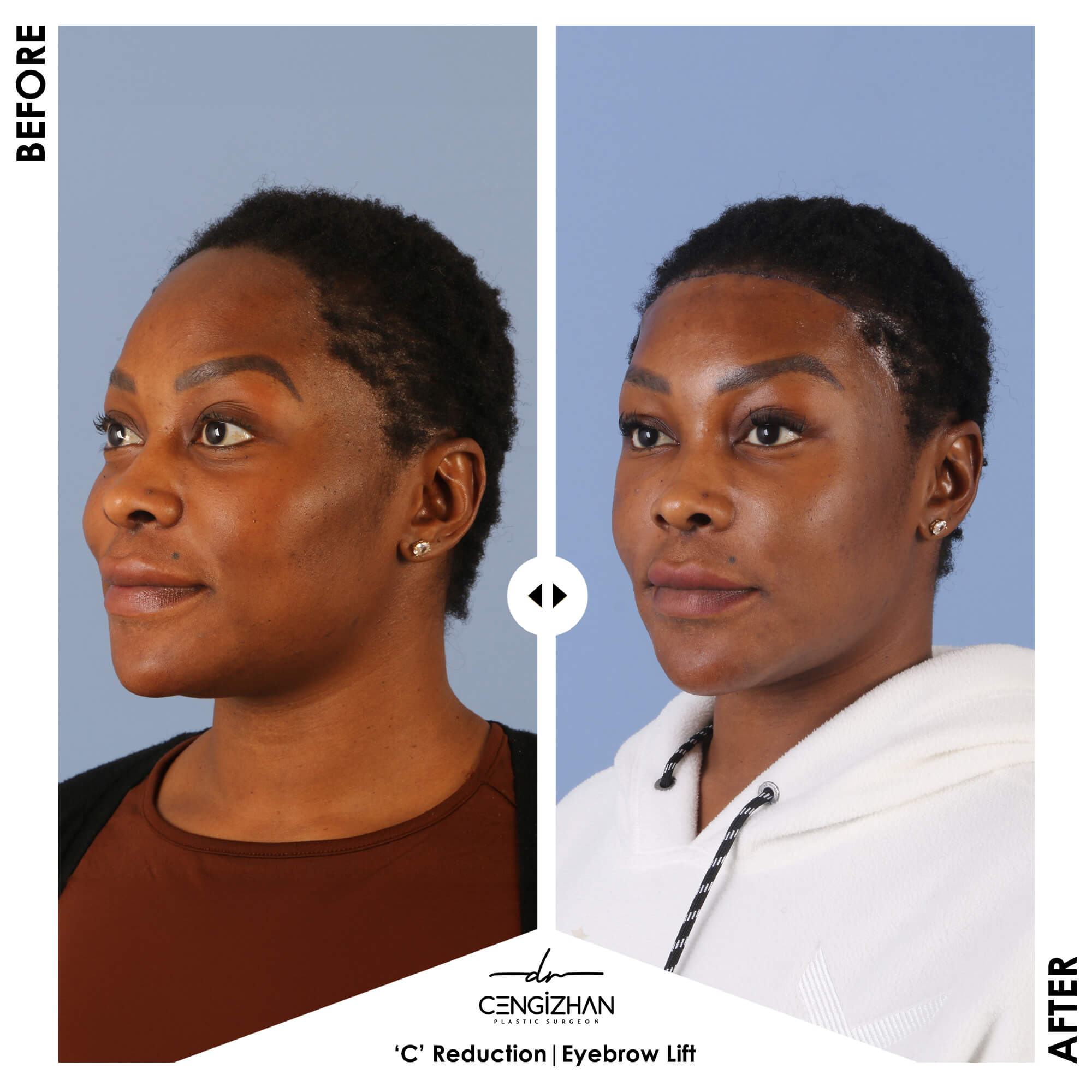 Forehead Reduction vs. Hair Transplant - Dr. Cengizhan Ekizceli