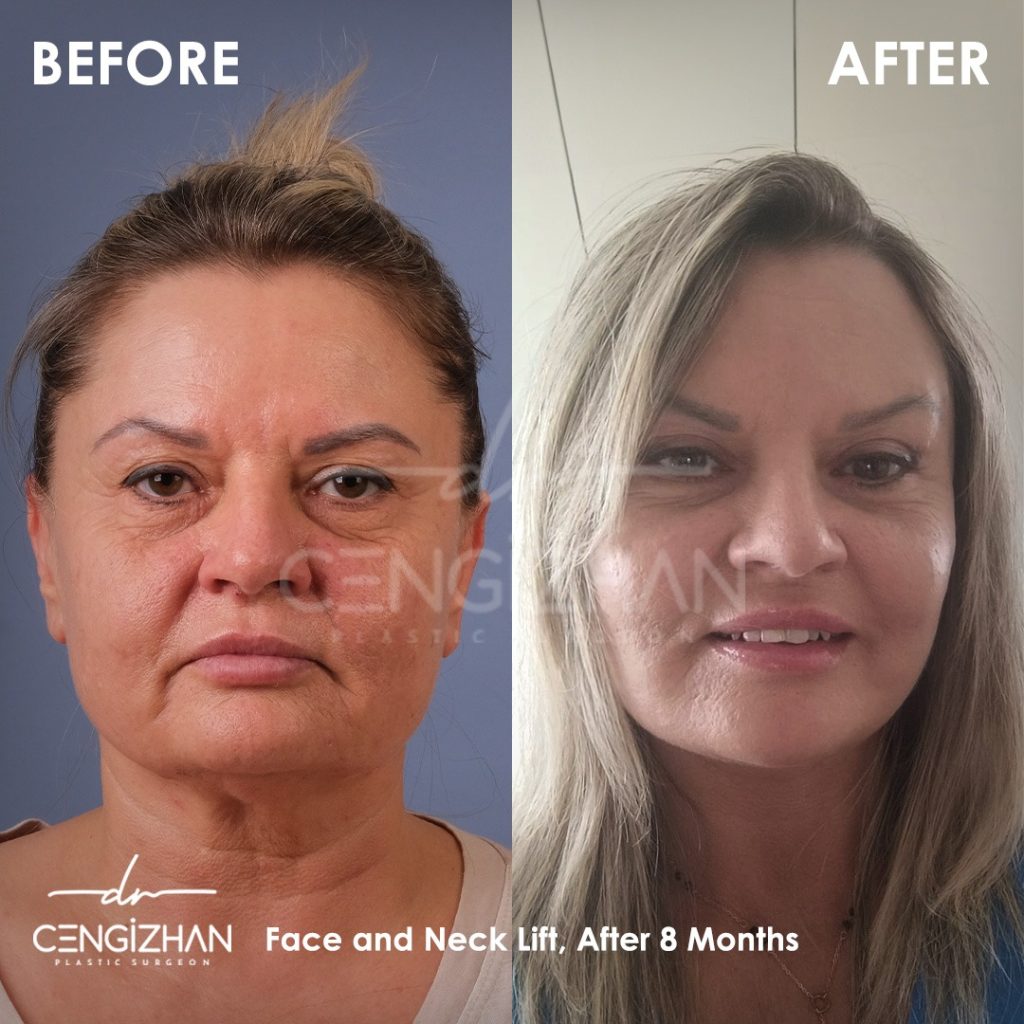 yuz-germe-11-1024×1024