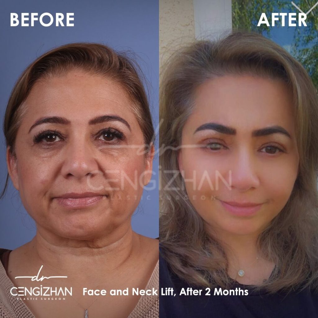 yuz-germe-12-1024×1024