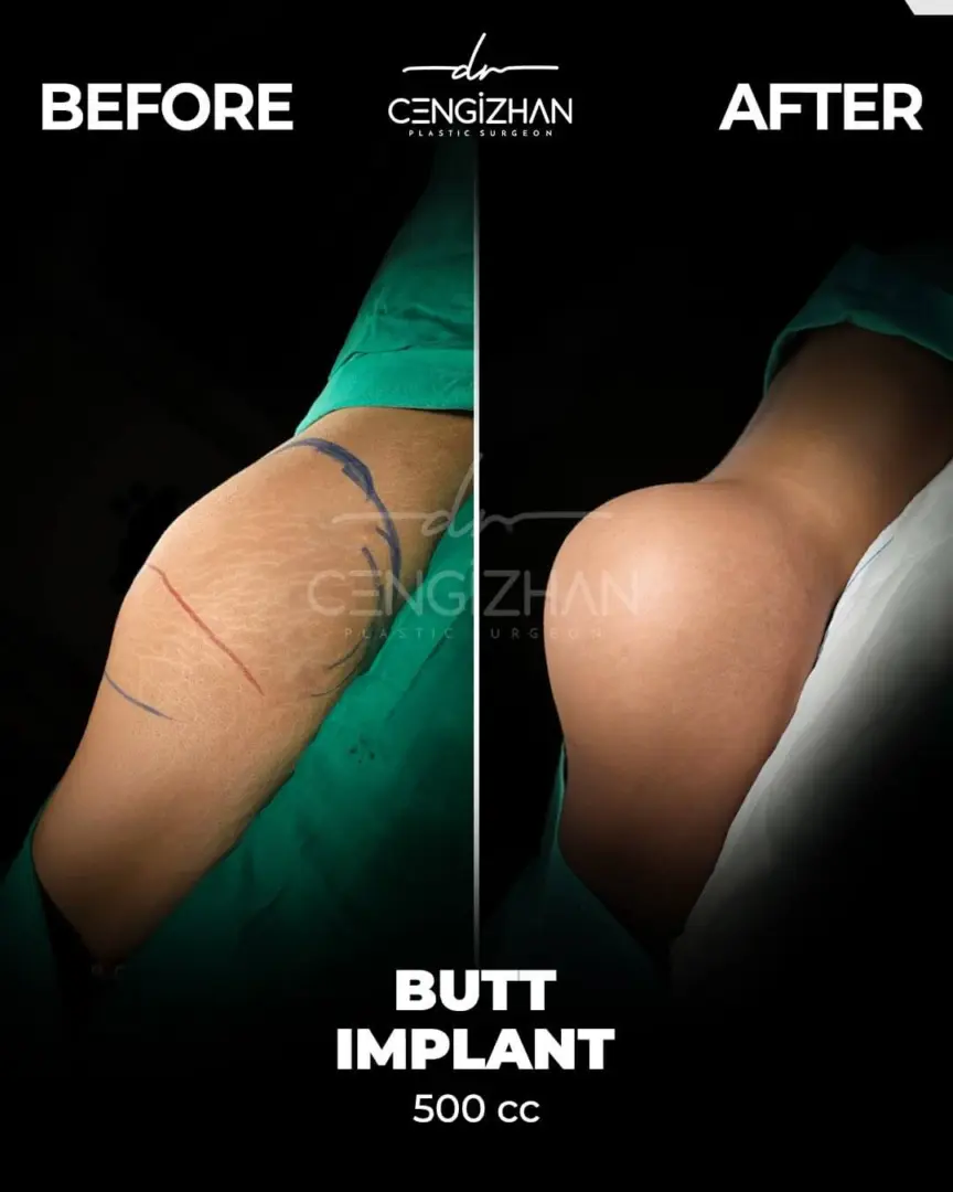 Résultats d'implants fessiers de 500 cc (avant-après) par le Dr Cengizhan Ekizceli
