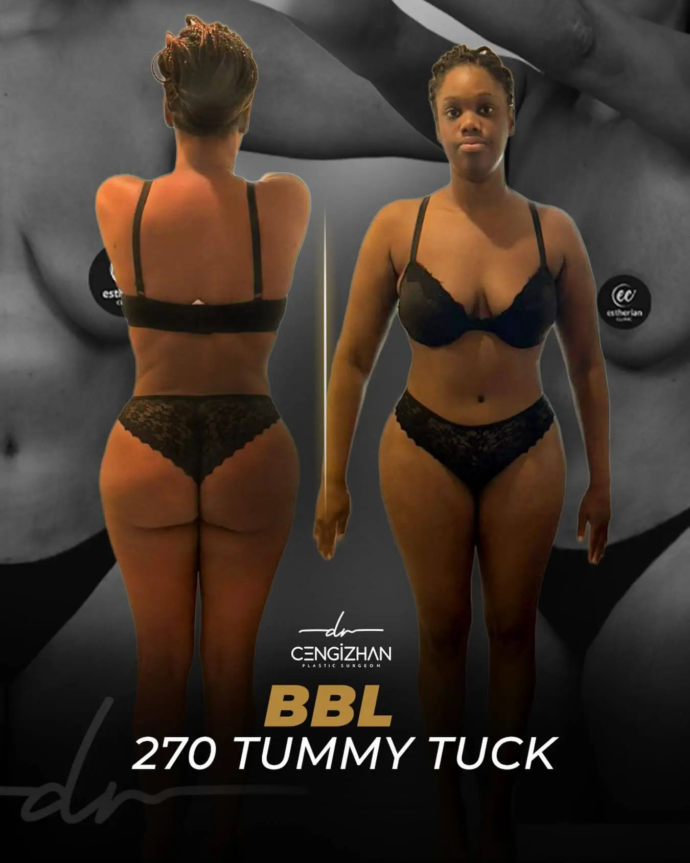 BBL and 270 Tummy Tuck By Dr. Cengizhan Ekizceli