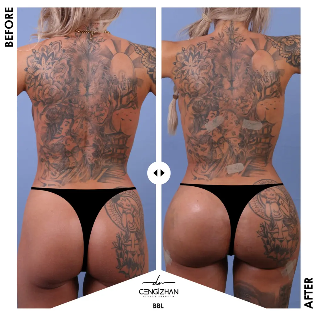 BBL (avant et après) par le Dr Cengizhan Ekizceli