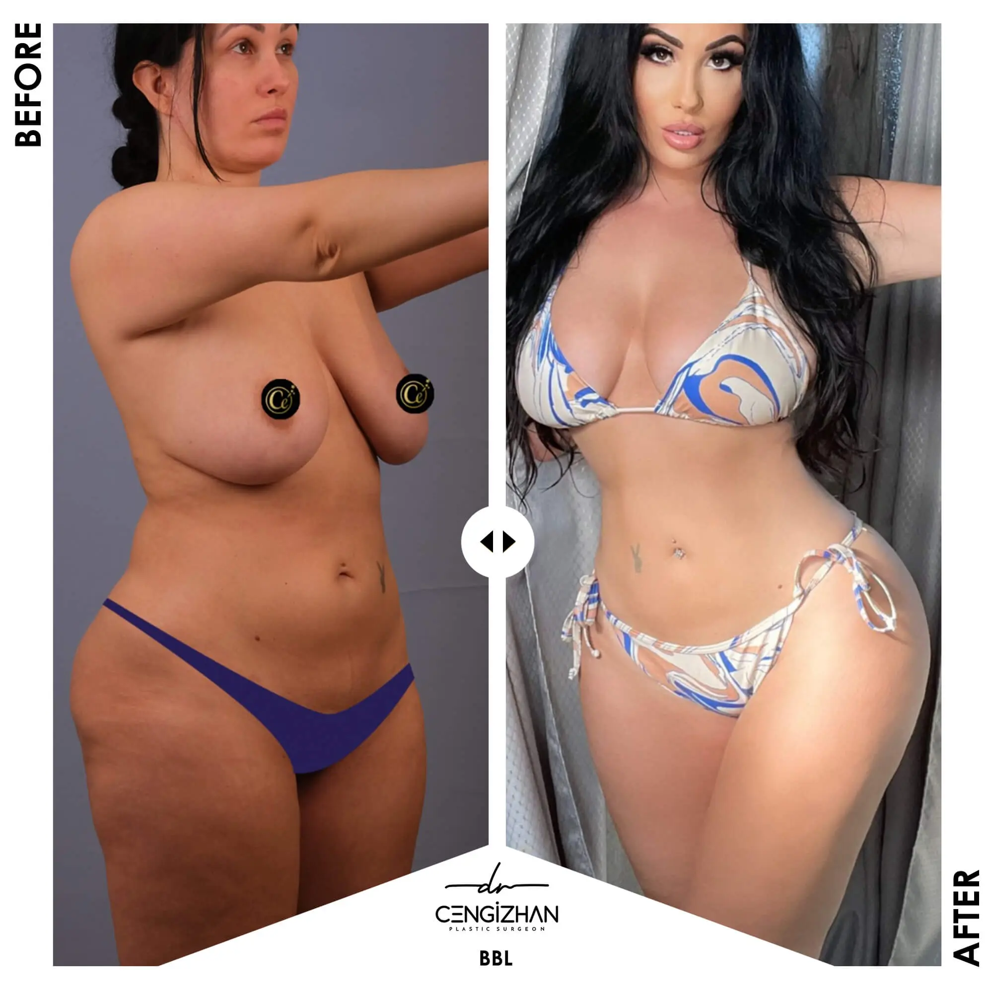 BBL by Dr. Cengizhan Ekizceli