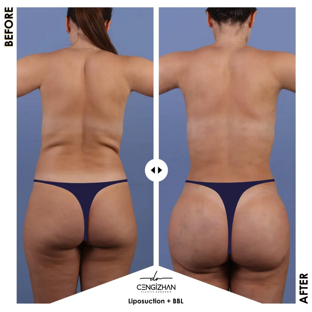 Lifting brésilien des fesses par le Dr Cengizhan Ekizceli