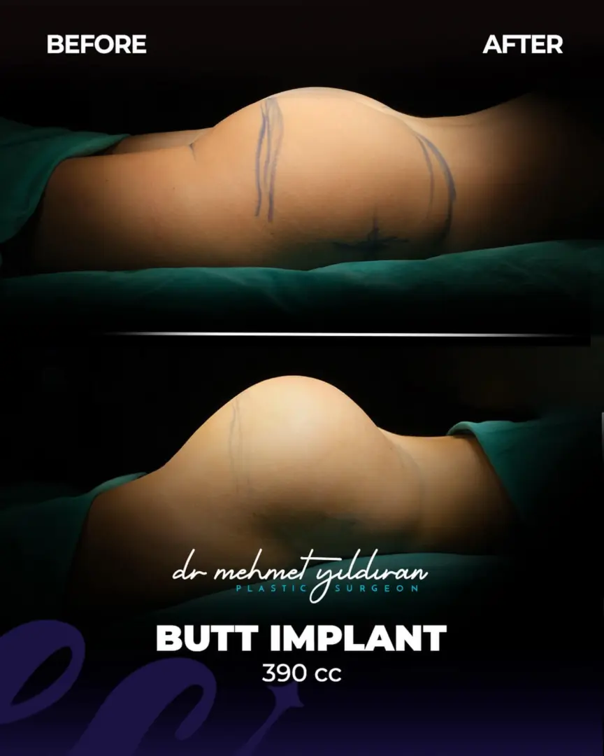 Résultats des implants fessiers réalisés par le Dr Cengizhan Ekizceli (390 cc)