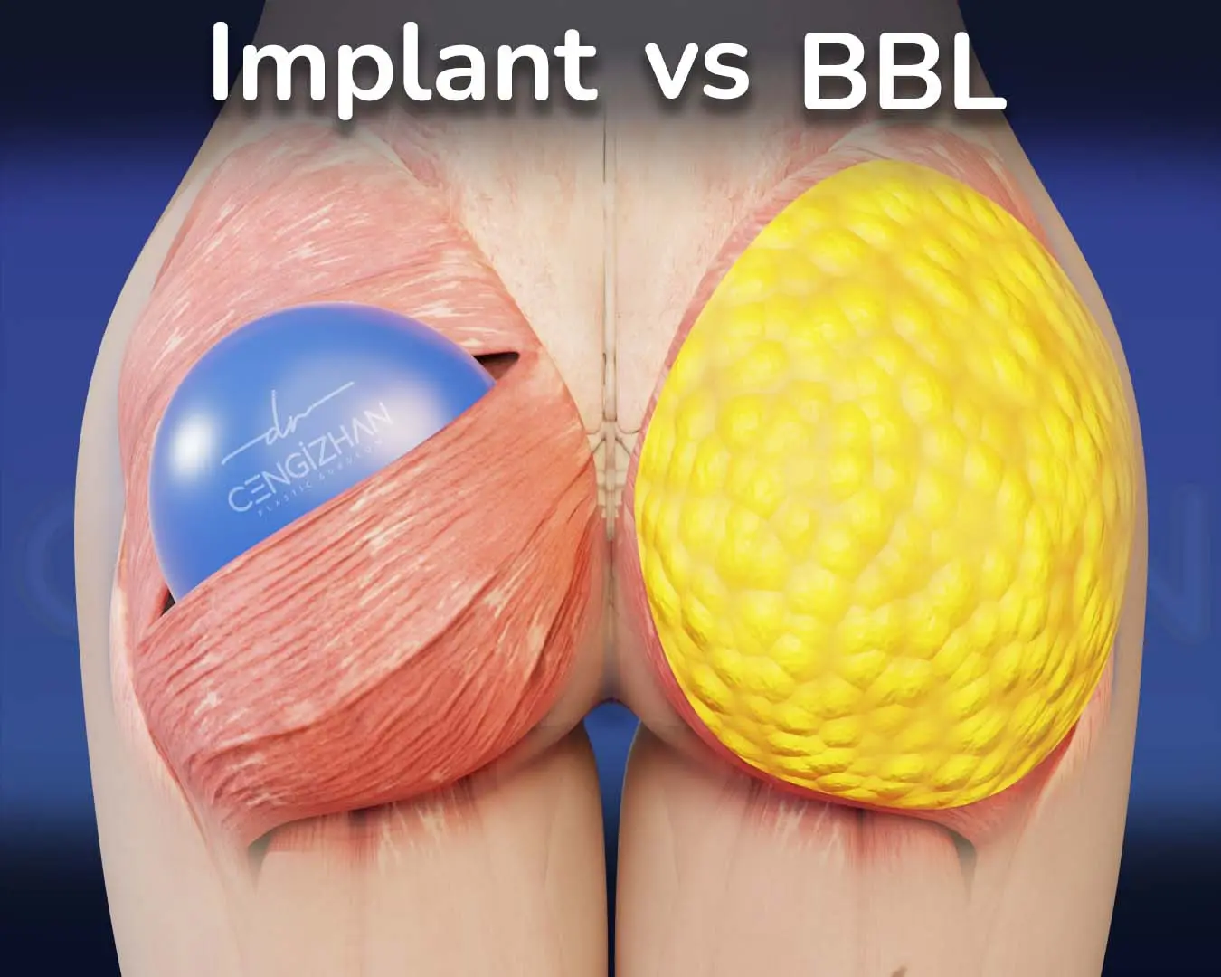 Butt-Implant-vs-BBL A Guide by Dr. Cengizhan Ekizceli