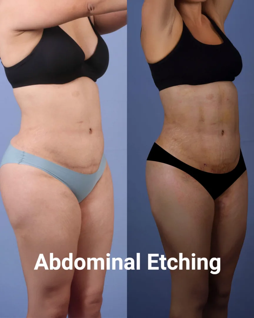 abdominal etching woman before after