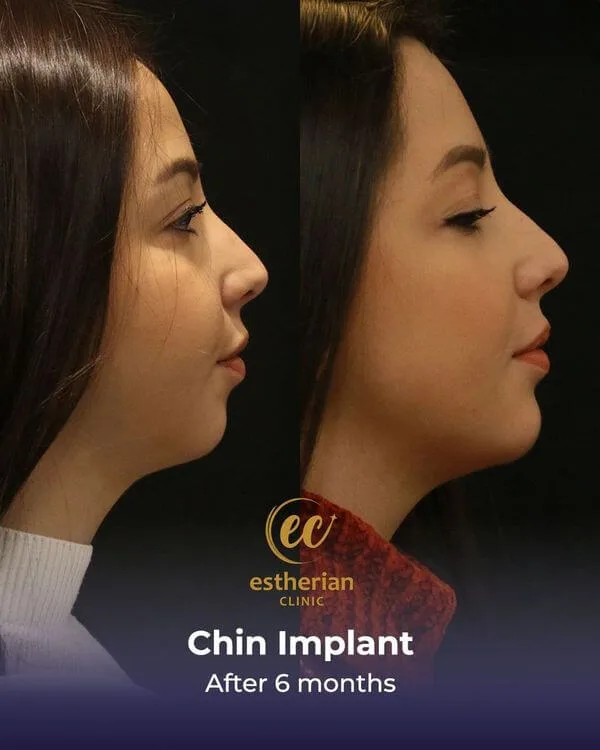 Chin implant after 6 months (image credits: estherian.com)