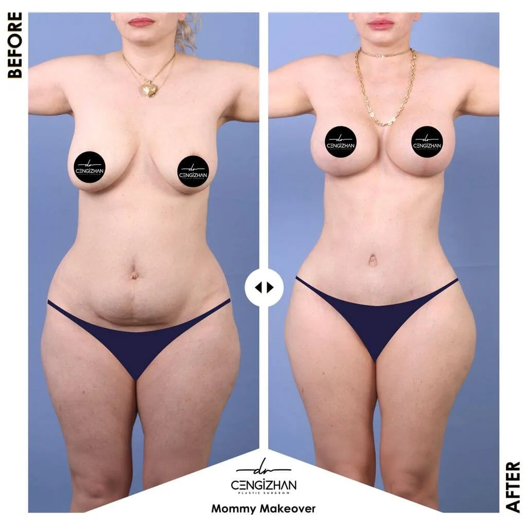 Mommy Makeover by Dr. Cengizhan