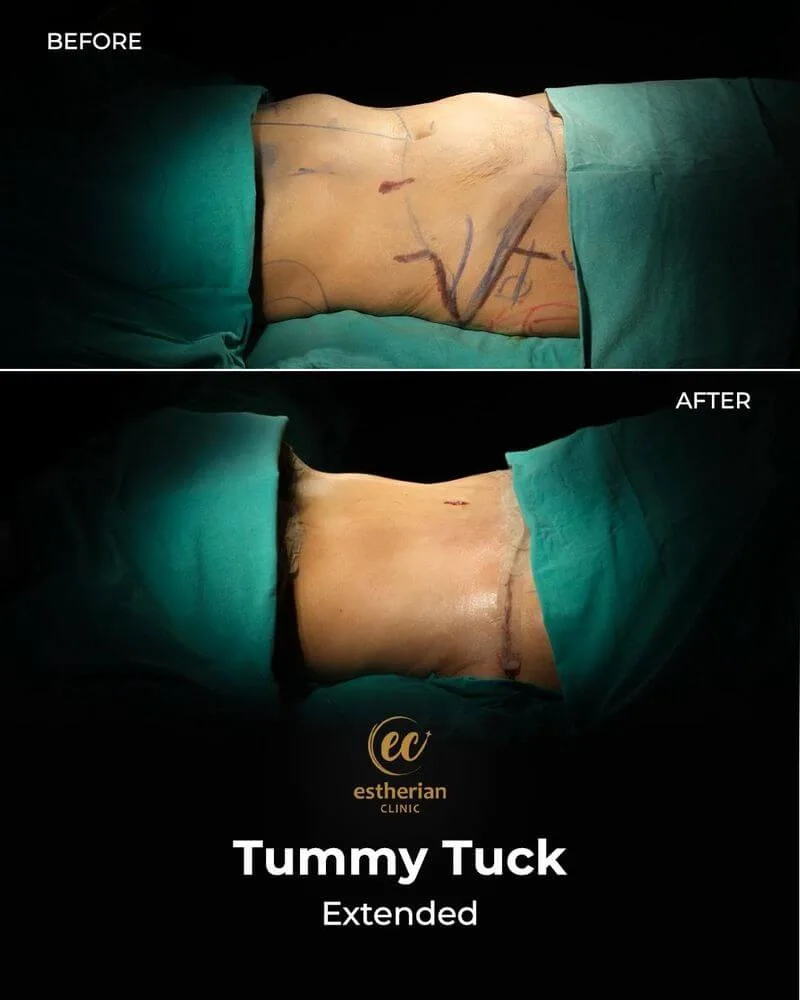 Tummy Tuck (before and after)