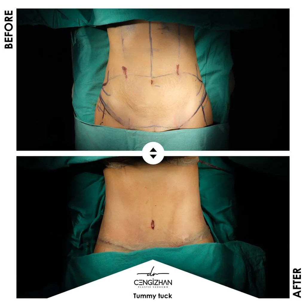 Tummy tuck by Dr. Cengizhan