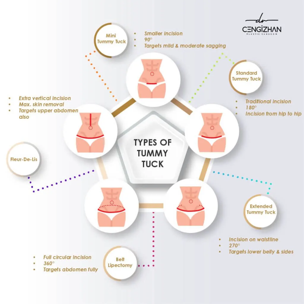 Types of tummy tuck