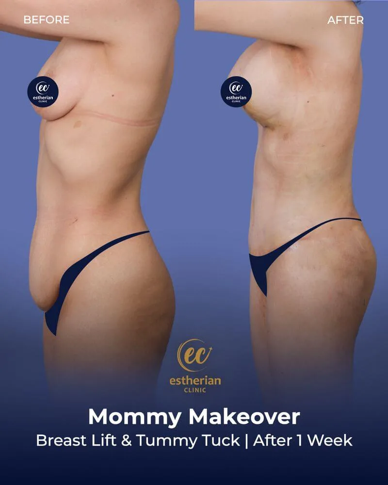 breast lift and tummy tuck after 1 week