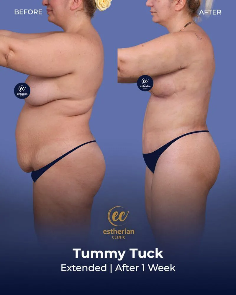 tummy tuck (extended) after 1 week