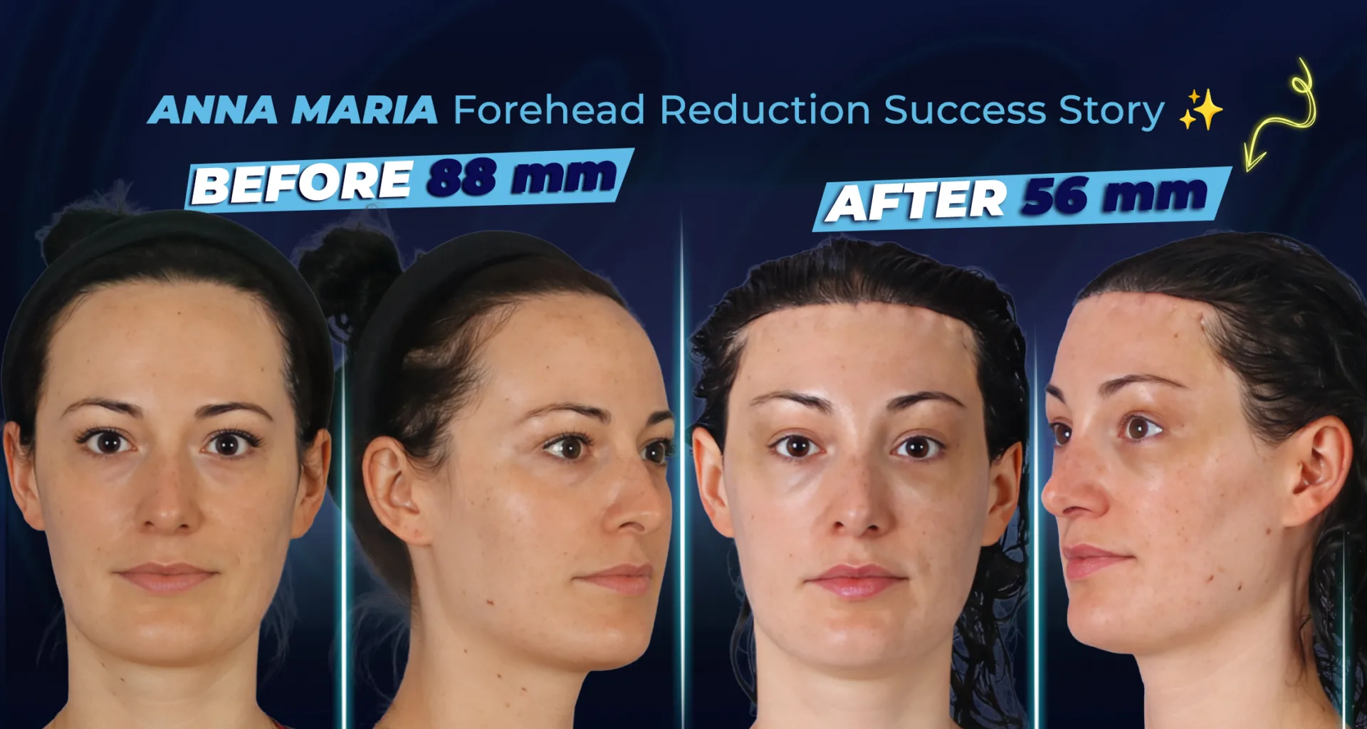 Témoignage d'une patiente : La chirurgie de réduction du front d'Anna