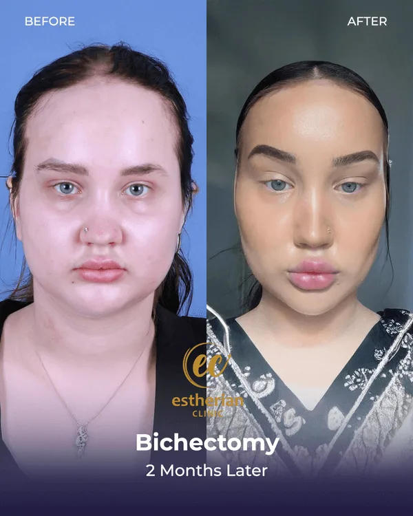 Bichectomy (2 months later) before and after