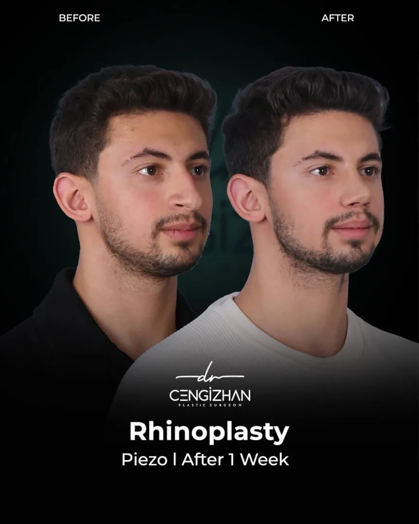 Ethnic Rhinoasty by Dr. Cengizhan (before and after)