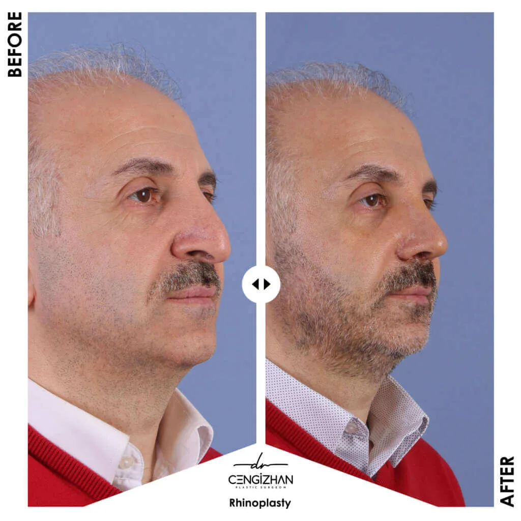 Ethnic Rhinoplasty in Turkey by Dr. Cengizhan (before and after)