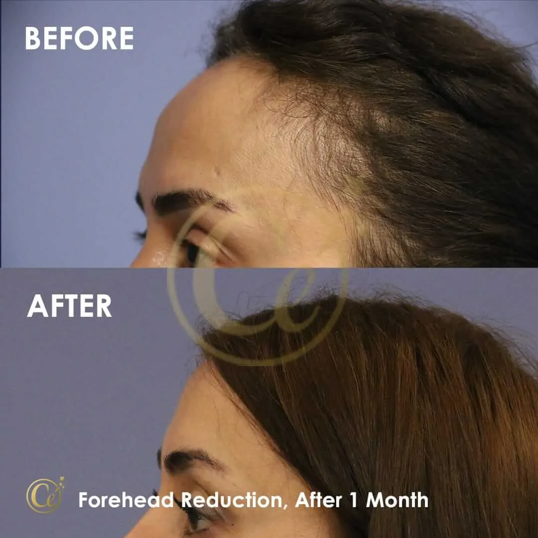 Forehead Reduction, after 1 month
