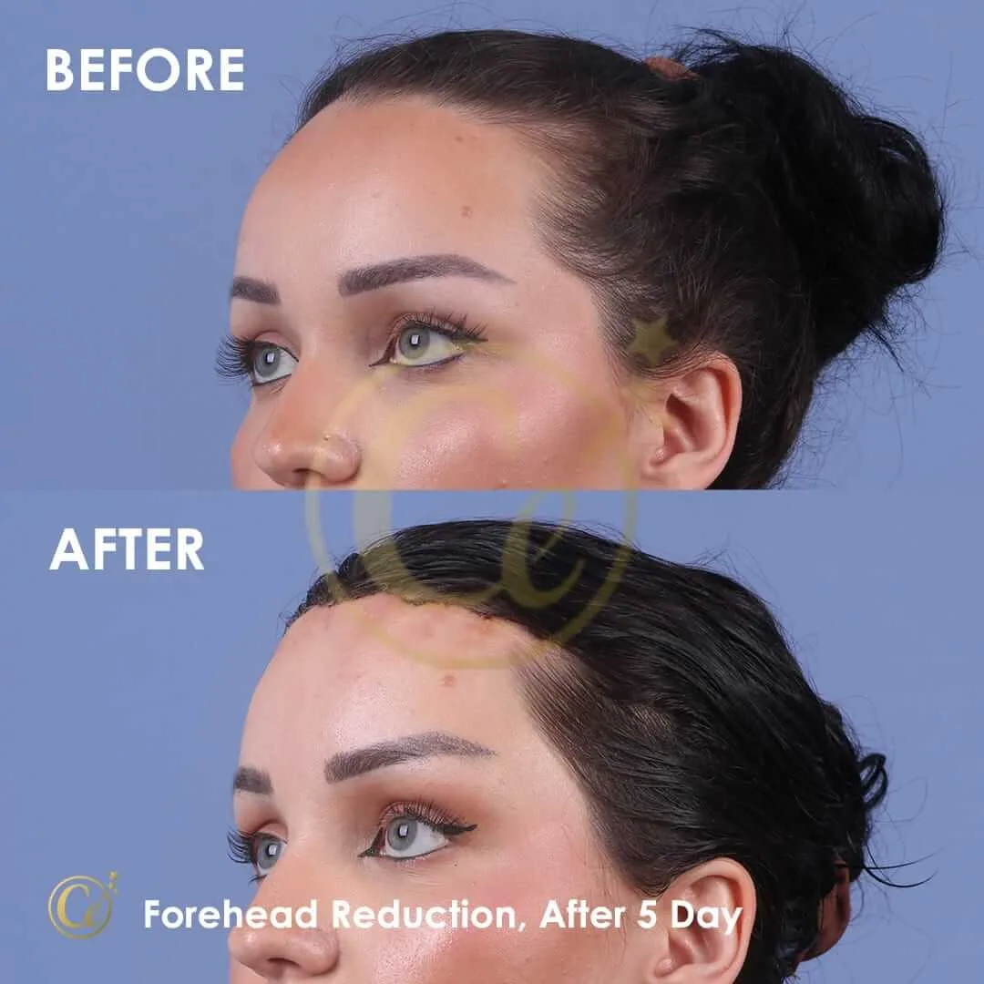 Forehead reduction, after 5 days