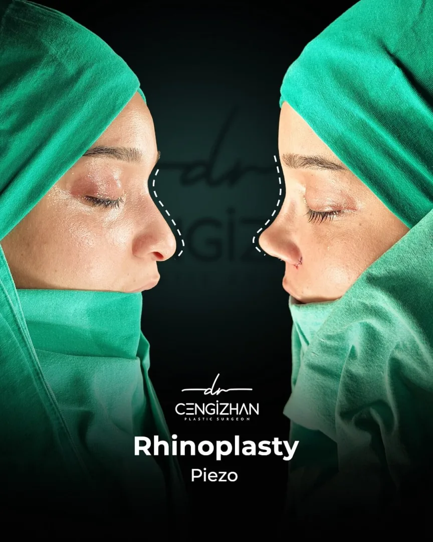 Rhinoplasty before and after by Dr Cengizhan