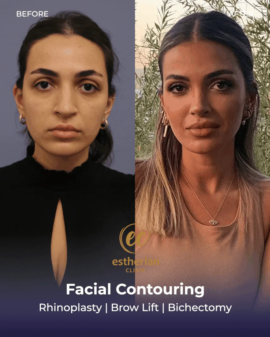 Rhinoplasty, brow lift, bichectomy (before and after)