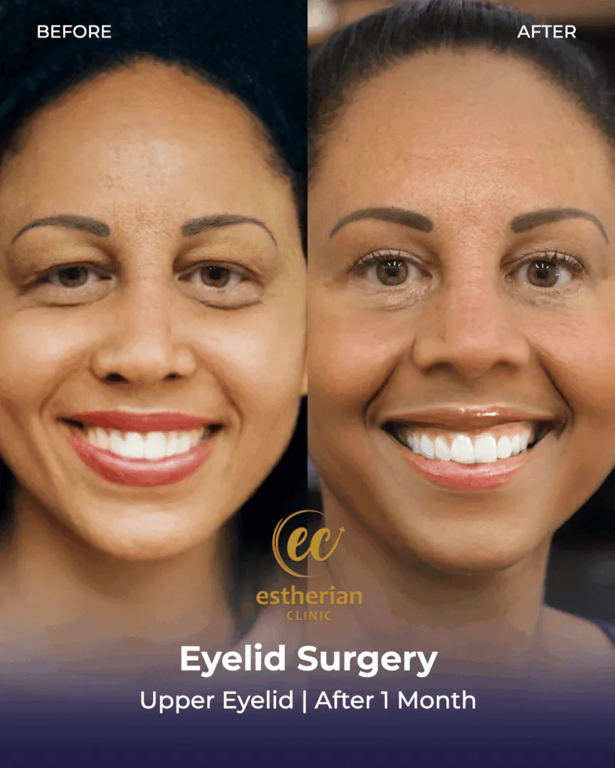 Upper eyelid surgery results after 1 month (before and after)