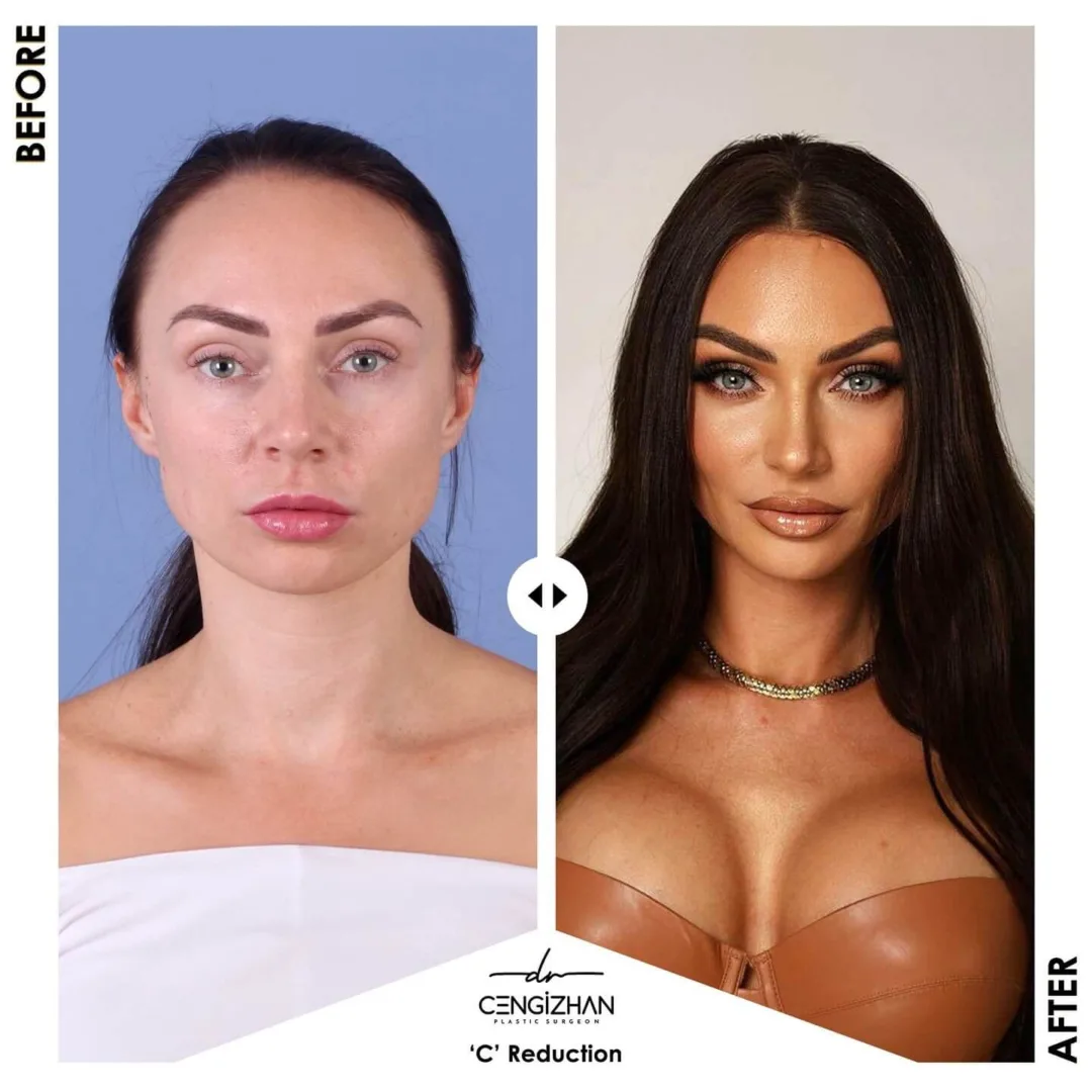 C reduction or forehead reduction surgery by Dr. Cengizhan before and after