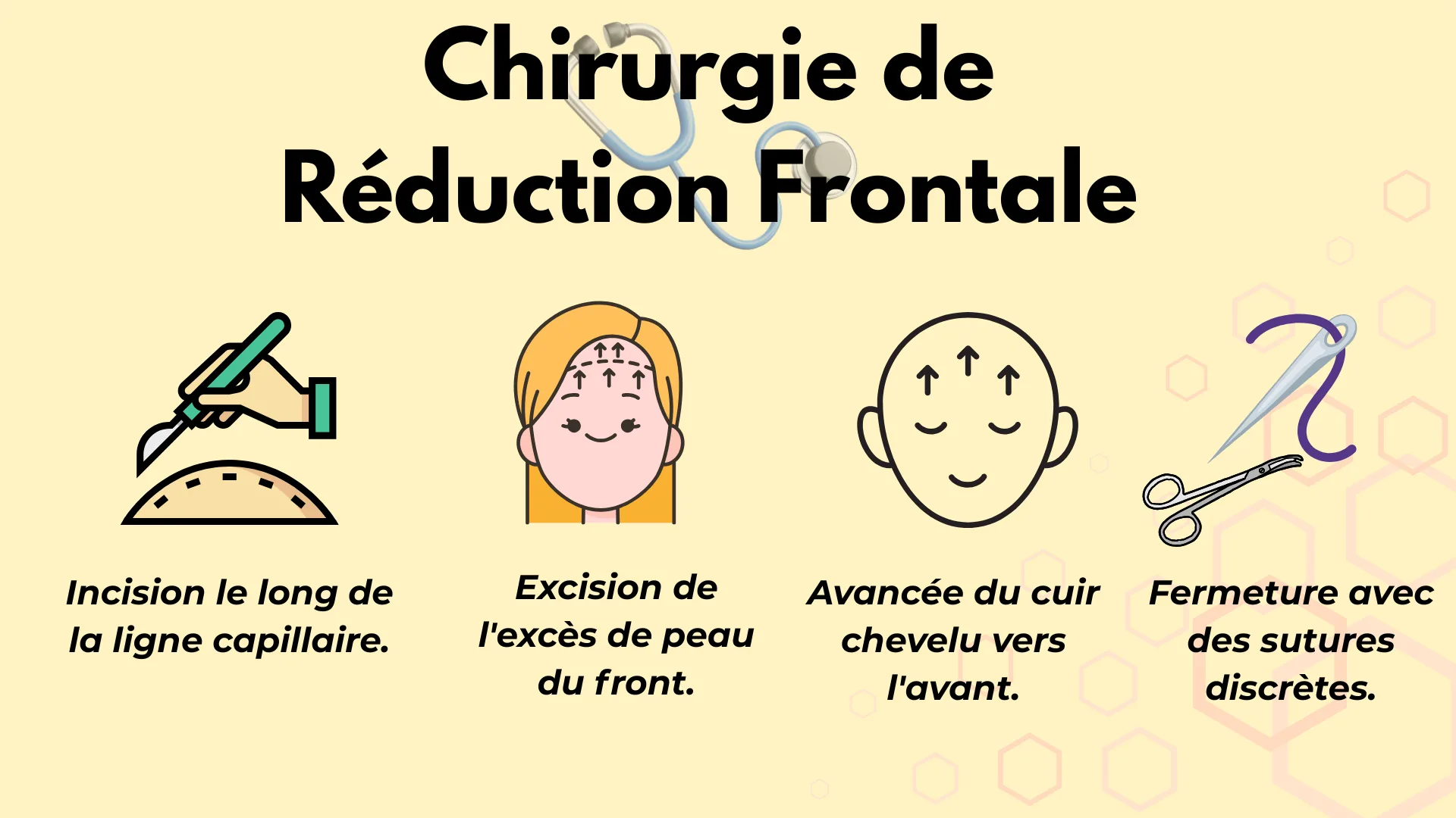Chirurgie de Réduction Frontale