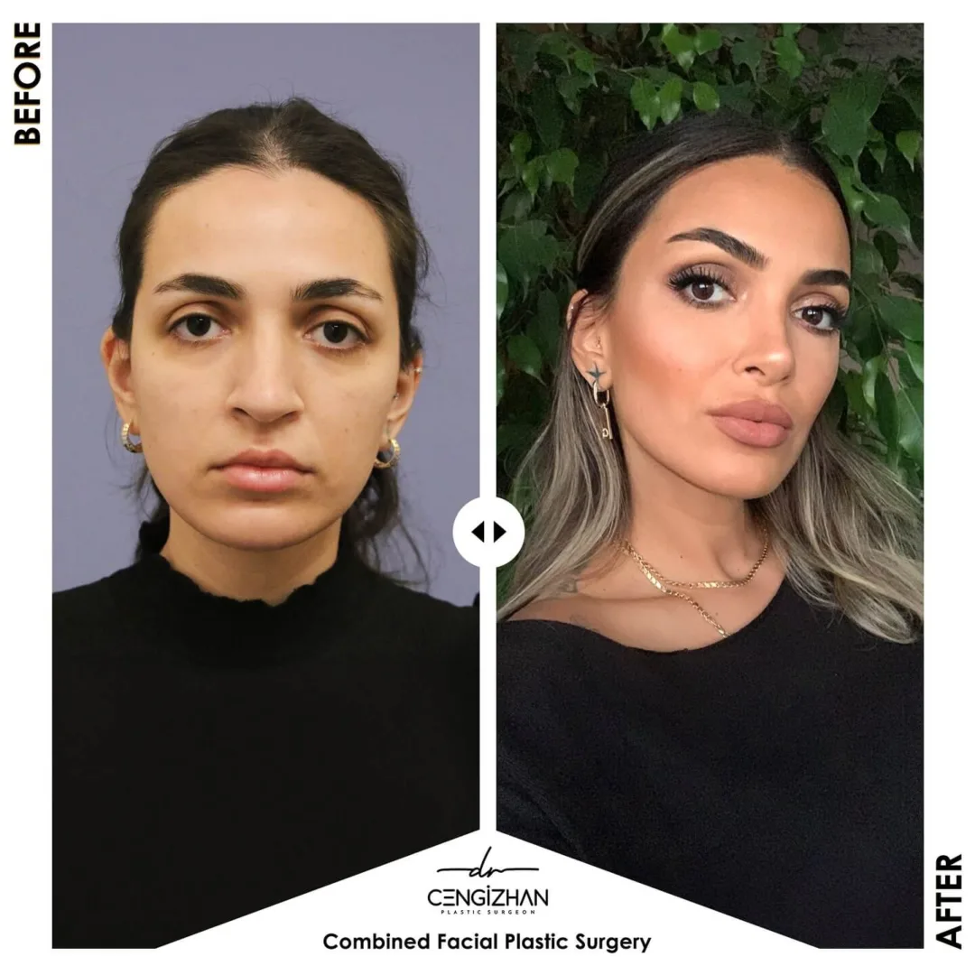 Combined facial plastic surgery before and after by Dr. Cengizhan (rhinoplasty, eyebrow lift, bichectomy, face fat injection procedures)
