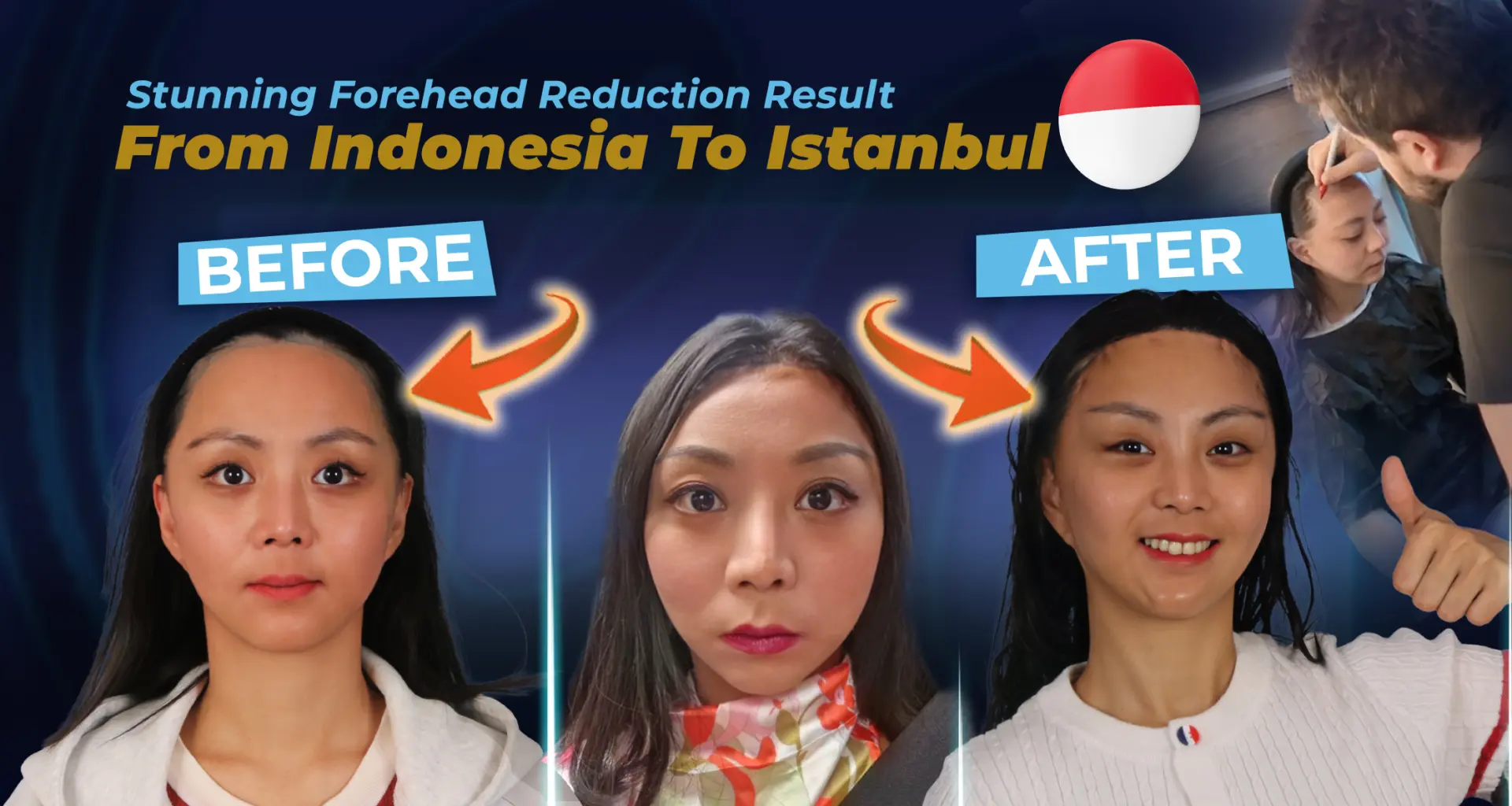 Témoignage d'une patiente : Chirurgie de réduction du front