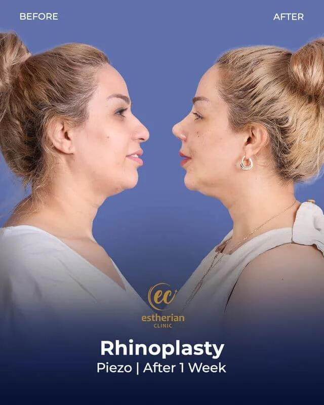 Rhinoplasty (before and after) results after 1 week