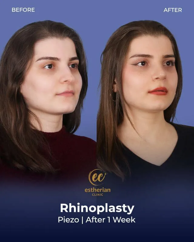 Rhinoplasty results after 1 week