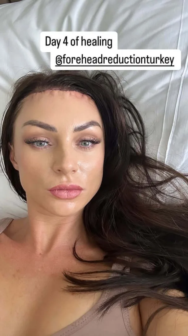 Triinu's day 4 of healing from forehead reduction surgery by Dr. Cengizhan
