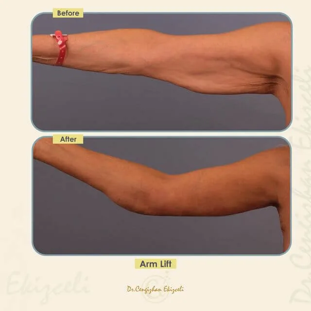 Arm lift before and after by Dr. Cengizhan