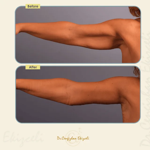 Arm lift by Dr. Cengzihan Ekizceli