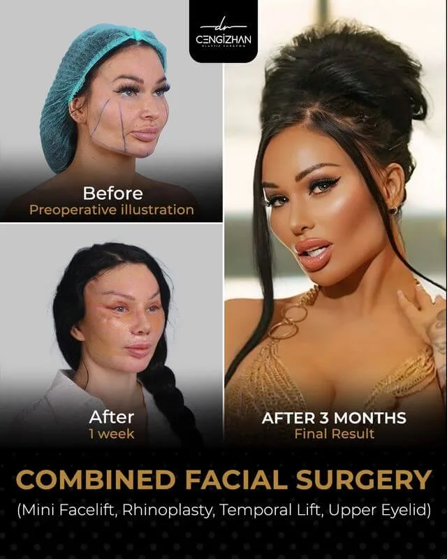 Ava Van Rose's  Combined Facial Surgery (Mini Facelift, Rhinoplasty, Temporal Lift, Upper Eyelid)