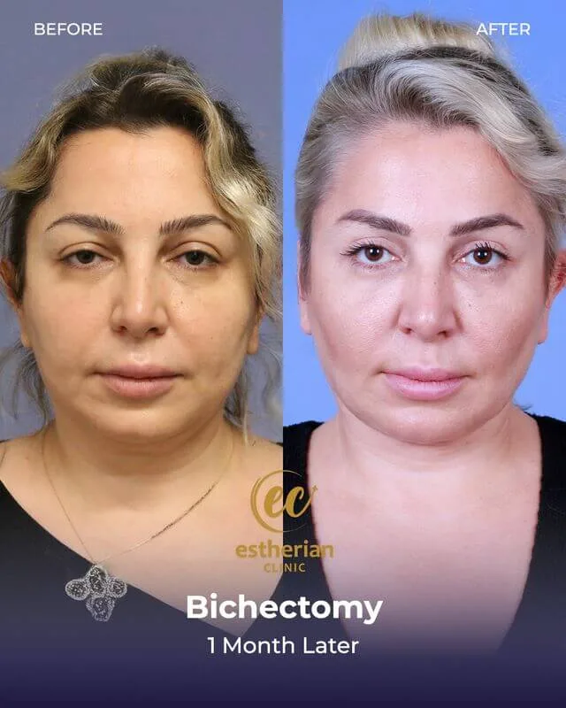 Bichectomy by the Estherian Clinic (before and after) results after 1 month