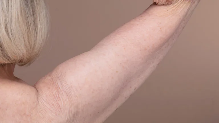 Brachioplasty Scars in Turkey How Surgeons Minimize Them