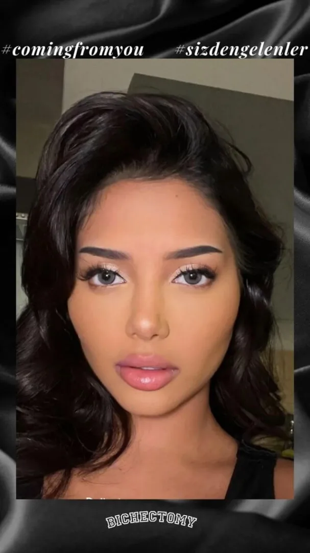 Buccal fat removal results by Dr. Cengizhan