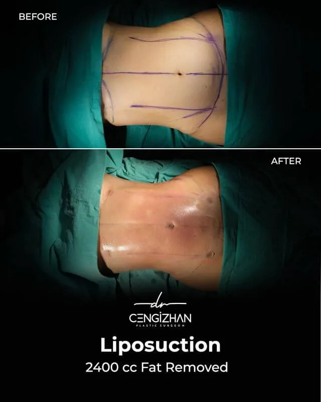 Liposuction (2400 cc fat removed) before and after