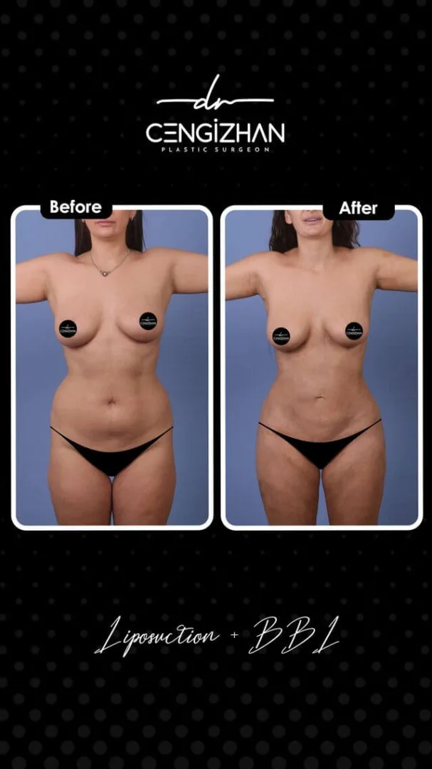 Liposuction and BBL with Dr. Cengizhan (before and after)