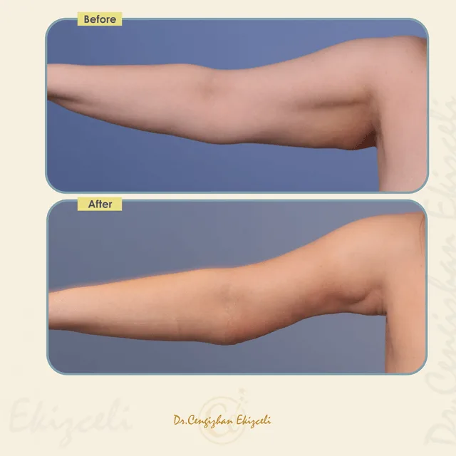 Arm lift results  by Dr. Cengizhan Ekizceli (before and after)