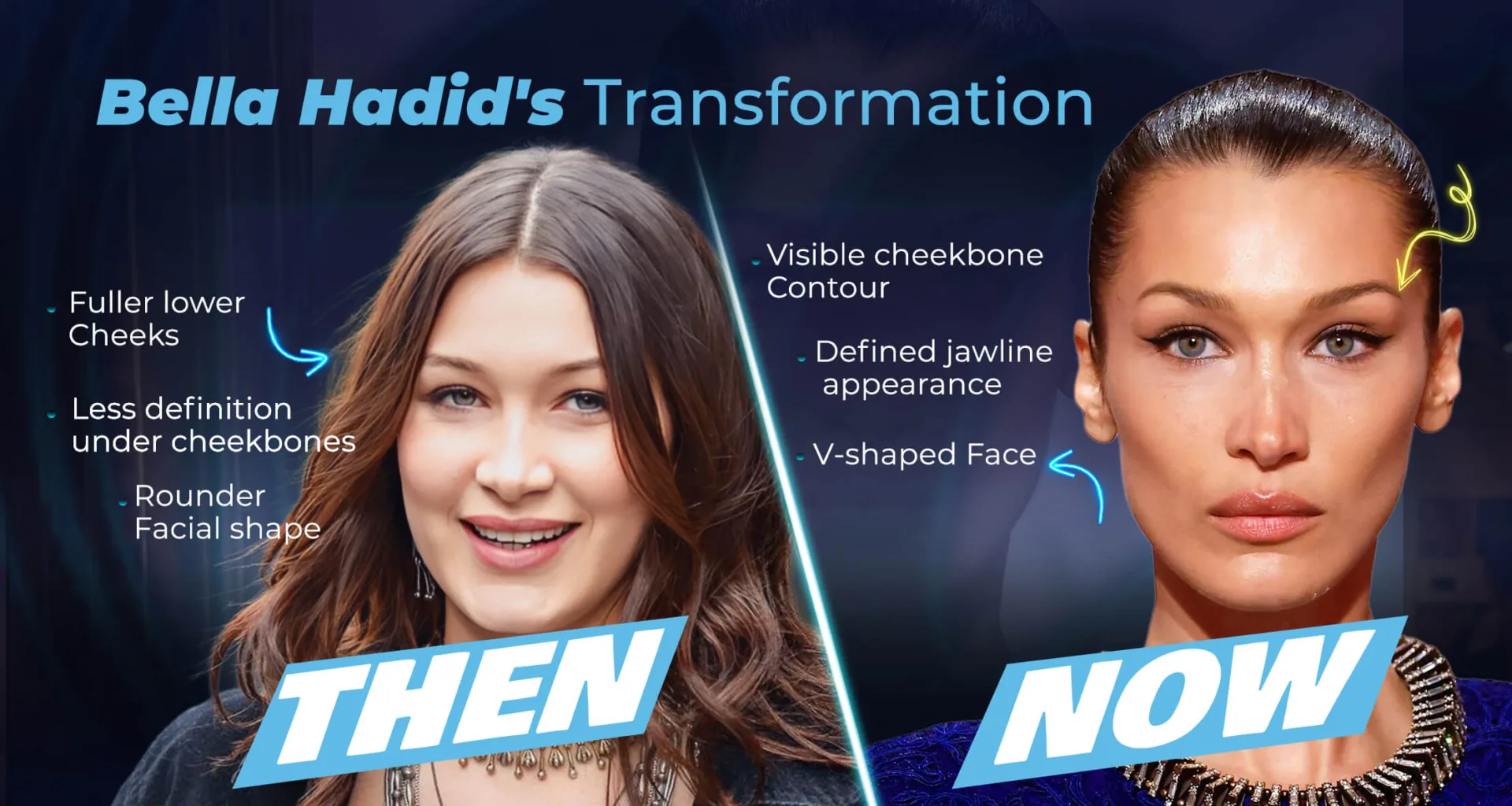 Bella Hadid's Bichectomy Transformation