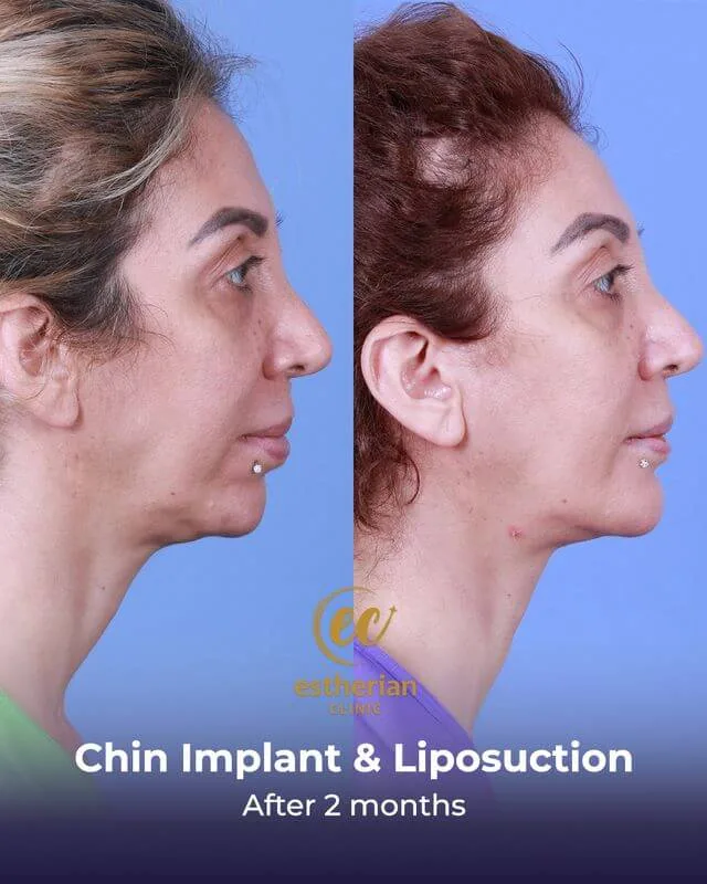 نتائج عملية زراعة الذقن وشفط الدهون بعد شهرين