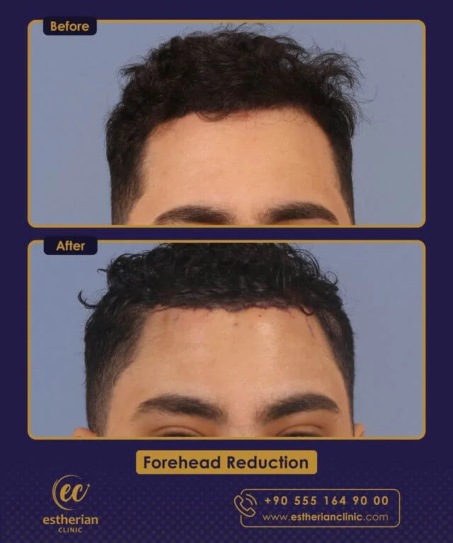 Chirurgie de réduction du front (avant et après) par la clinique Estherian