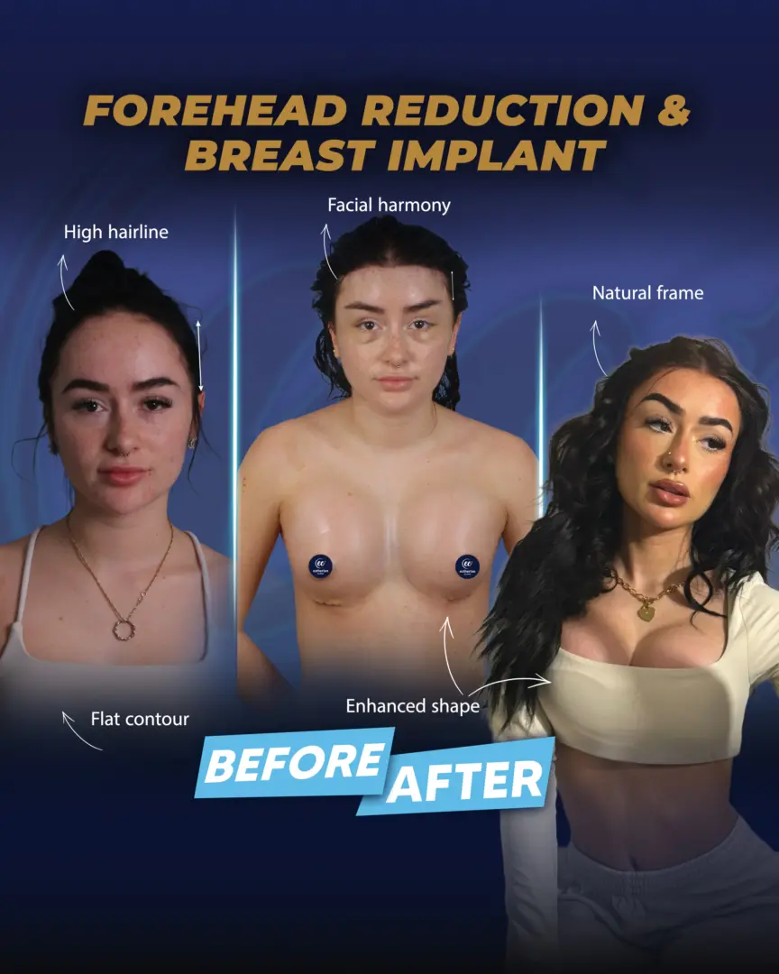 Forehead reduction and breast implants (patient success story) Dr cengizhan